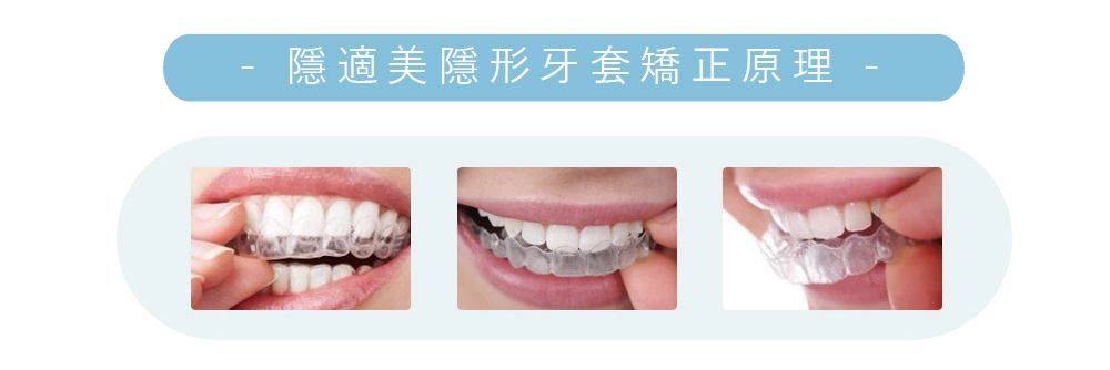 隱形牙套矯正