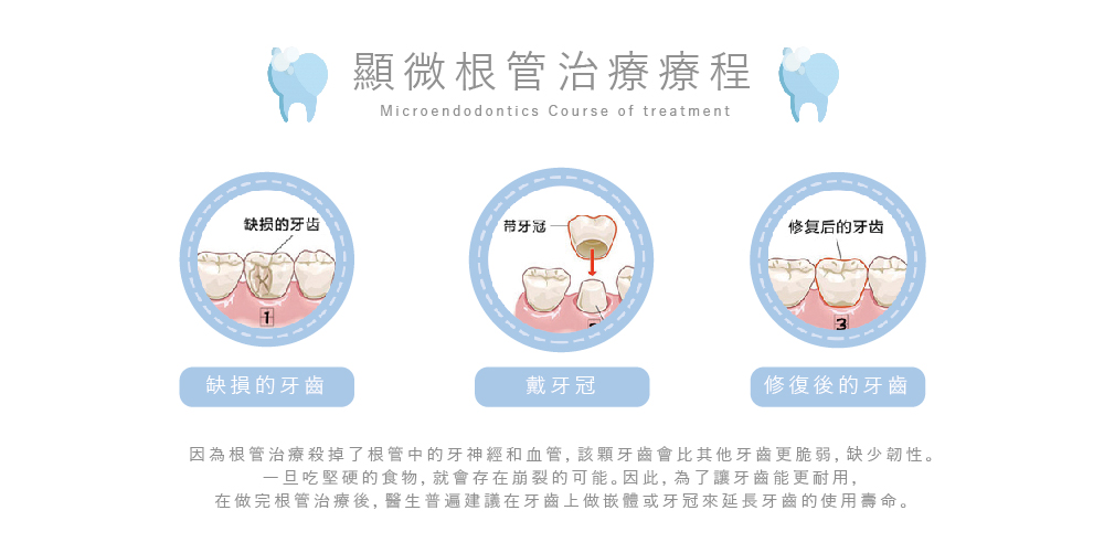 顯微根管治療 過程