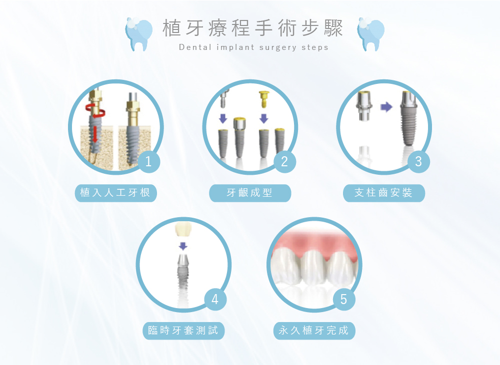 植牙手術流程