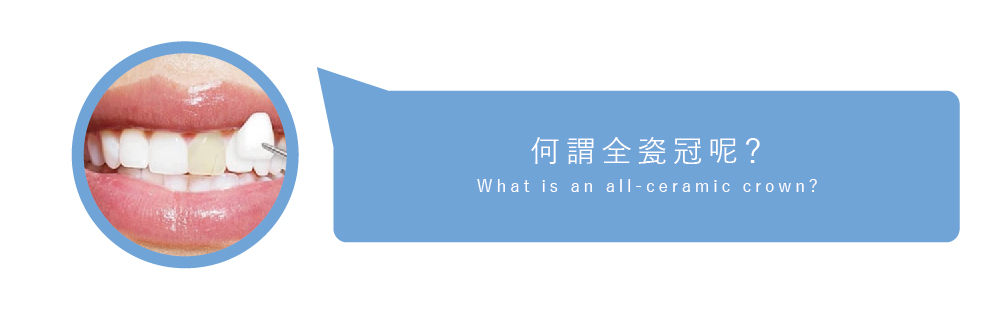 全瓷牙冠 介紹